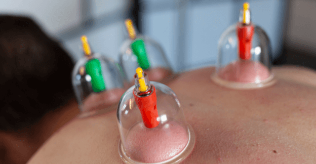 Dry Cupping CPD – 20th February